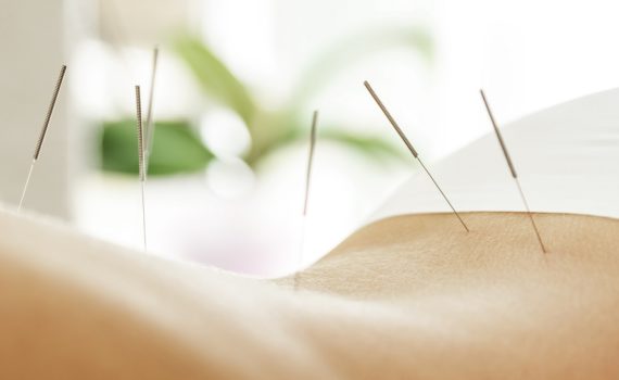 L’acupuncture peut-elle aider à perdre du poids